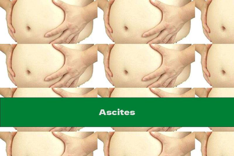 Ascites