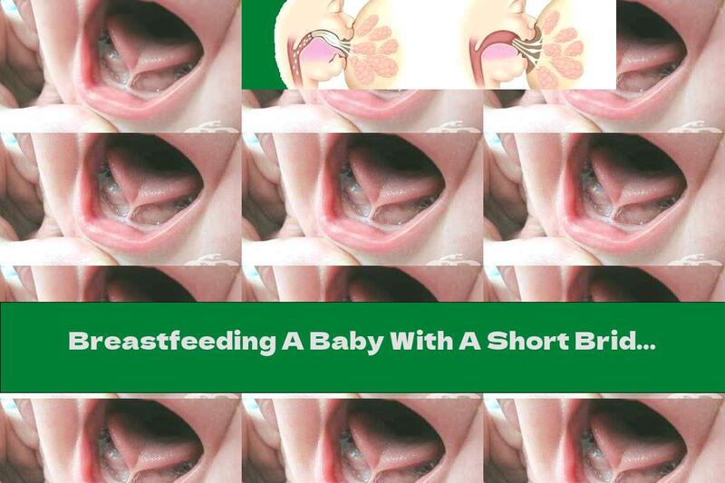 Breastfeeding A Baby With A Short Bridle On The Tongue