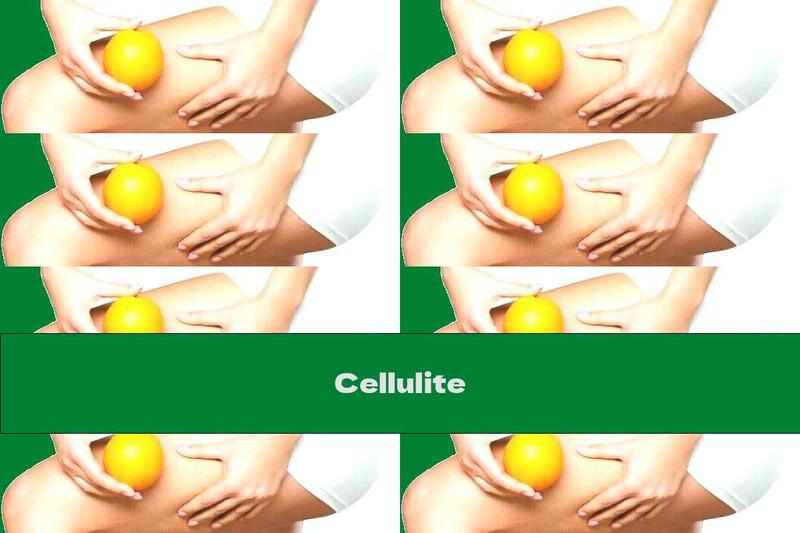 Cellulite