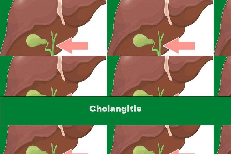 Cholangitis