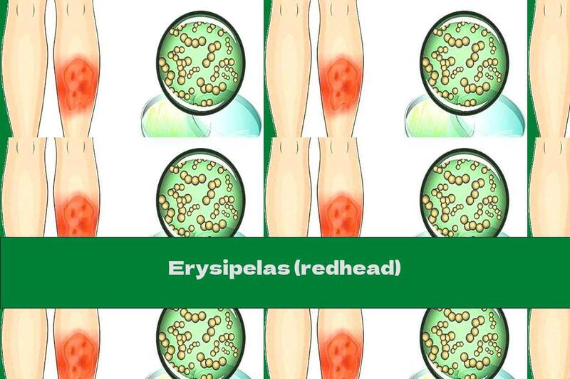 Erysipelas (redhead)