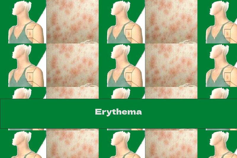 Erythema