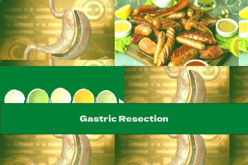 Gastric Resection