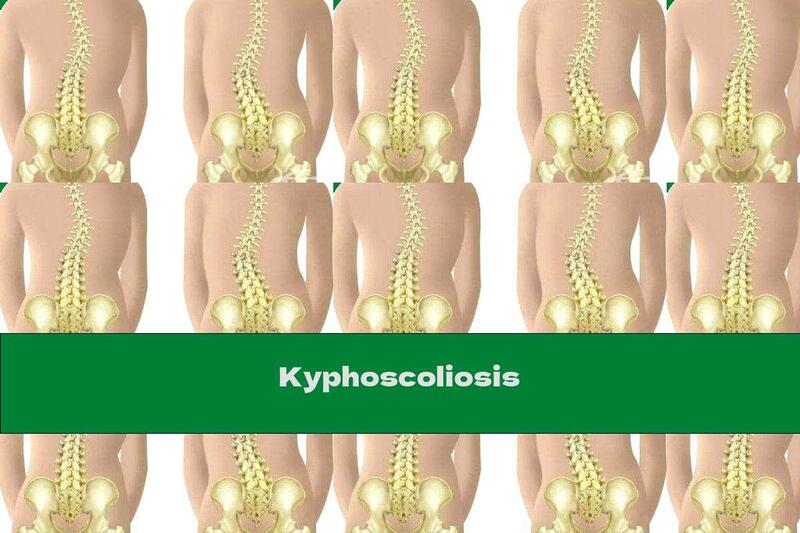 Kyphoscoliosis