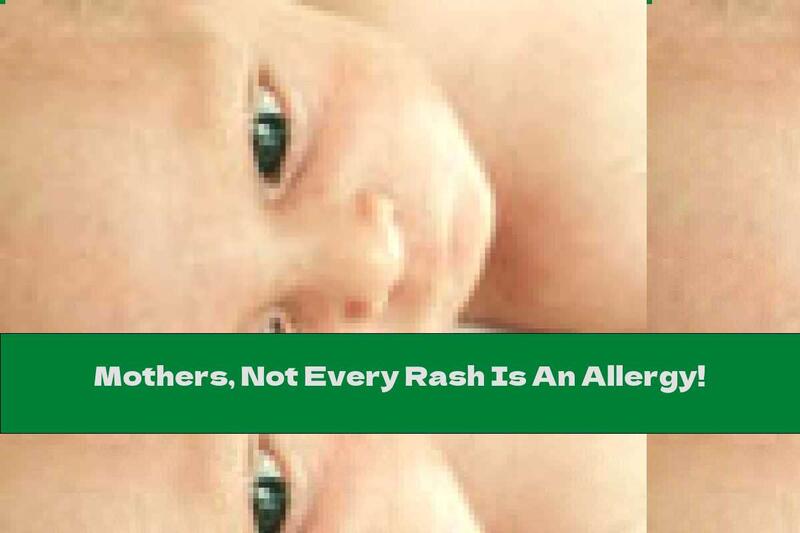 Mothers, Not Every Rash Is An Allergy!