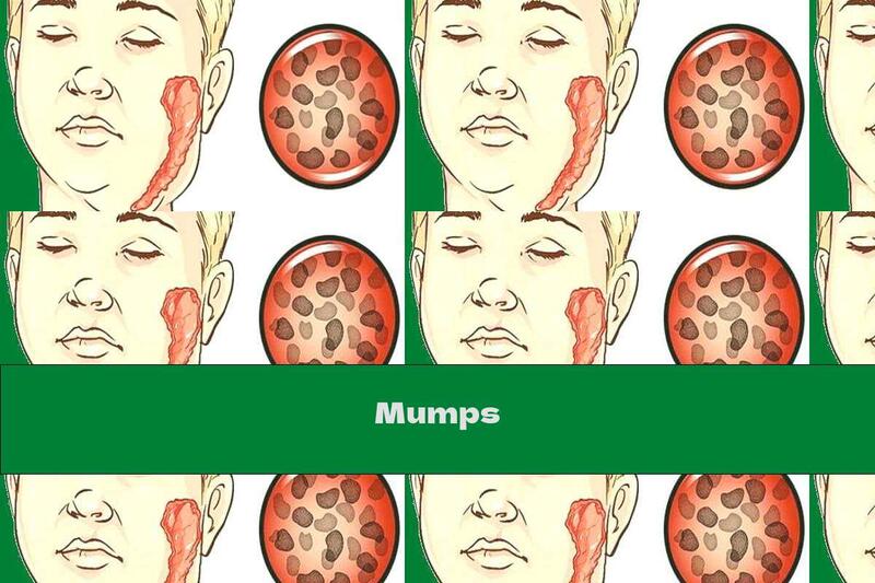 Mumps