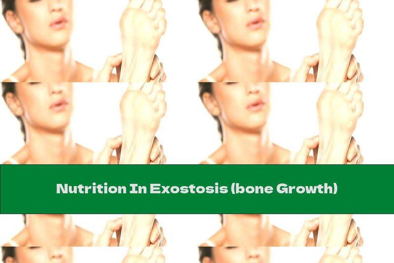 Nutrition In Exostosis (bone Growth)