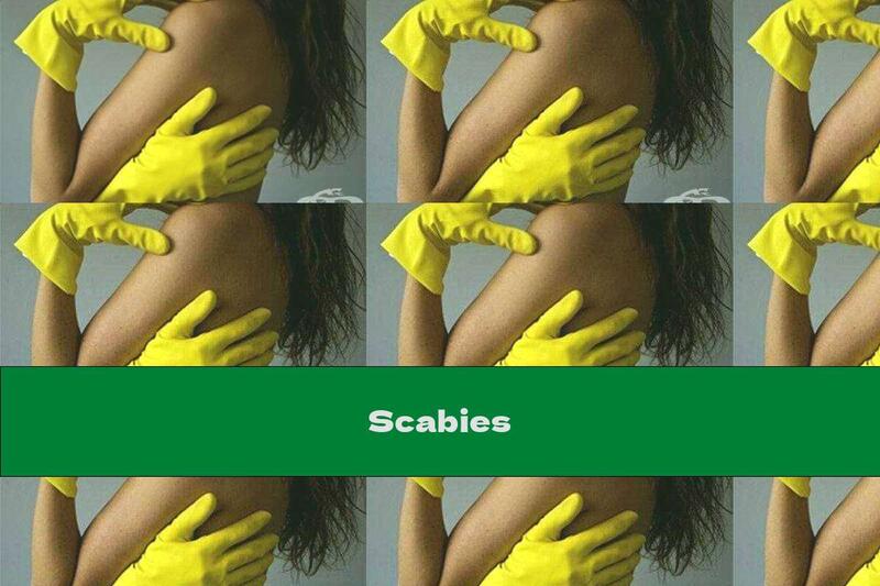 Scabies