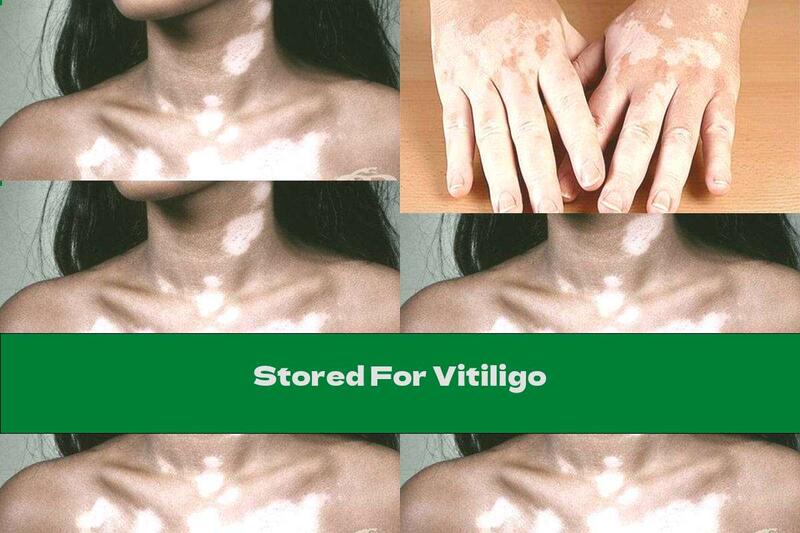 Stored For Vitiligo