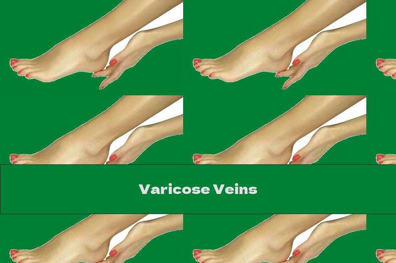 Varicose Veins